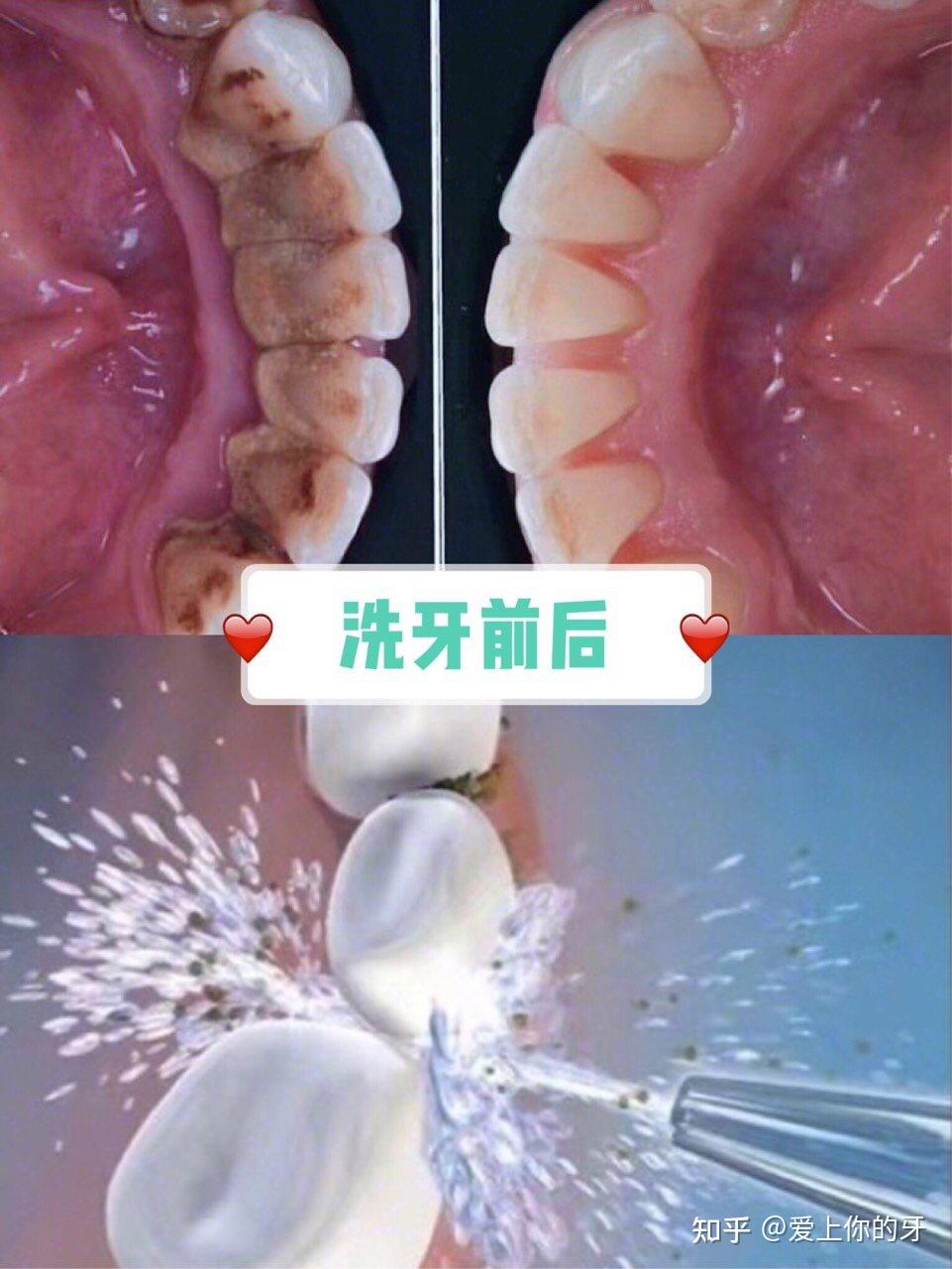 延安洗牙可以用医保吗(洗牙可以用医保吗,报销比例多少)